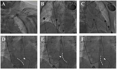 Feasibility and Safety of Left Bundle Branch Pacing for Advance Aged Patients: A Multicenter Comparative Study